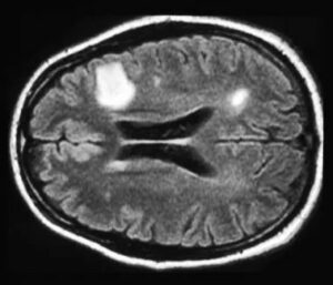 Cerveau d'un patient atteint de sclérose en plaque