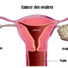 Cancer des ovaires